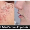 MarCarbun - Clear Skin Extrakt