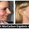 MarCarbun - Clear Skin Extrakt