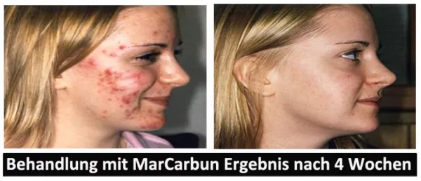 MarCarbun - Clear Skin Extrakt