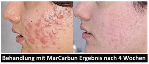MarCarbun - Clear Skin Extrakt